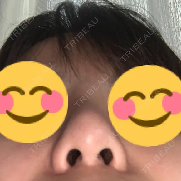 隆鼻術 たにまちクリニック AFTER メイン用