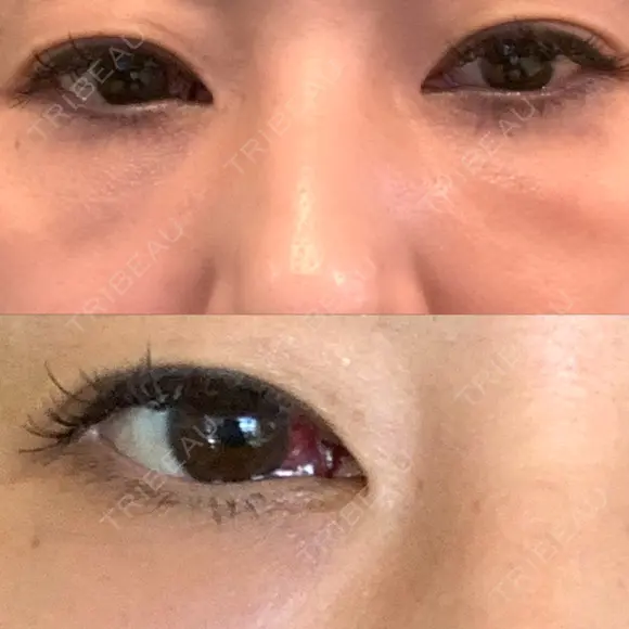 クマ治療 / 下まぶたたるみ取り / 下まぶたの脂肪取り 品川美容外科 渋谷院（※品川スキンクリニック提携） DAY 1 メイン用