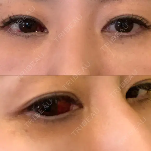 クマ治療 / 下まぶたたるみ取り / 下まぶたの脂肪取り 品川美容外科 渋谷院（※品川スキンクリニック提携） DAY 2 メイン用