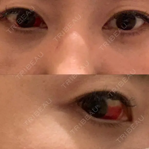 クマ治療 / 下まぶたたるみ取り / 下まぶたの脂肪取り 品川美容外科 渋谷院（※品川スキンクリニック提携） DAY 7 メイン用