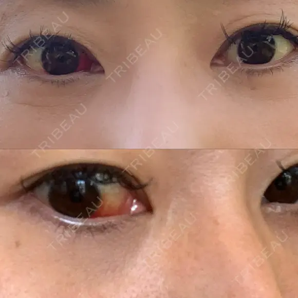 クマ治療 / 下まぶたたるみ取り / 下まぶたの脂肪取り 品川美容外科 渋谷院（※品川スキンクリニック提携） DAY 10 メイン用