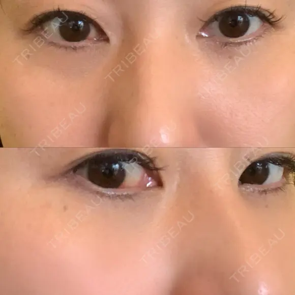 クマ治療 / 下まぶたたるみ取り / 下まぶたの脂肪取り 品川美容外科 渋谷院（※品川スキンクリニック提携） AFTER メイン用