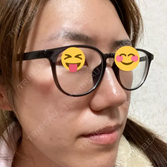 脂肪溶解注射（顔） / PRP皮膚再生療法 閉院｜プルージュ美容クリニック 赤羽院 DAY 14 メイン用