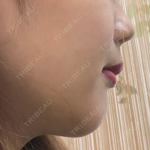 その他（輪郭） / その他（審美歯科/矯正歯科） 湘南美容クリニック 新宿本院 AFTER メイン用