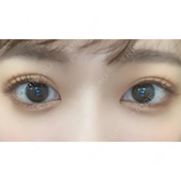 二重切開 / タレ目形成・グラマラスライン（切開） ハナキクリニック DAY 45 メイン用