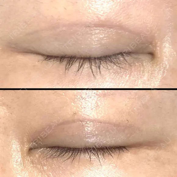 二重切開 / 眼瞼下垂（切開） / 上まぶたの脂肪取り / タレ目形成・グラマラスライン（切開） / 目尻靭帯移動 エイペックス美容外科 DAY 90 メイン用