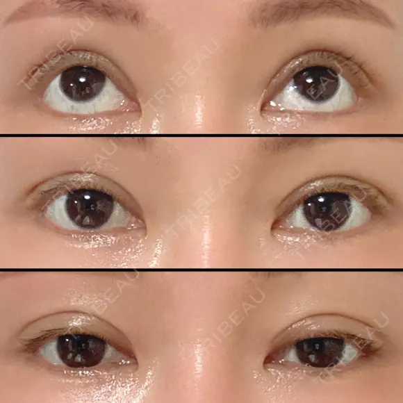 二重切開 / 眼瞼下垂（切開） / 上まぶたの脂肪取り / タレ目形成・グラマラスライン（切開） / 目尻靭帯移動 エイペックス美容外科 DAY 90 メイン用