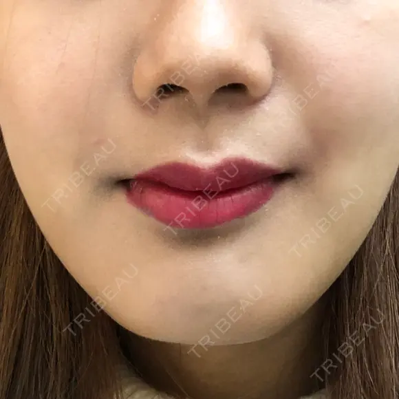 その他（輪郭） / その他（審美歯科/矯正歯科） 湘南美容クリニック 新宿本院 DAY 12 メイン用