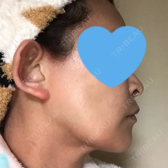 ハイフ（顔） / イオン導入 湘南美容クリニック 奈良院 DAY 31 メイン用