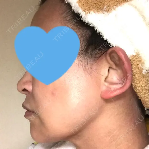 ハイフ（顔） / イオン導入 湘南美容クリニック 奈良院 DAY 31 メイン用