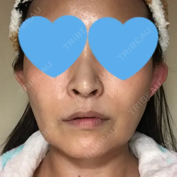 ハイフ（顔） / イオン導入 湘南美容クリニック 奈良院 DAY 31 メイン用