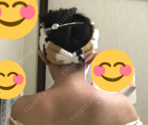 ボトックス（肩） 湘南美容クリニック 奈良院 DAY 31 メイン用