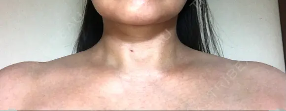 ボトックス（肩） 湘南美容クリニック 奈良院 AFTER メイン用