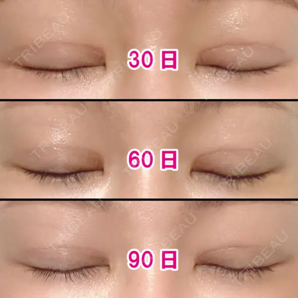 二重切開 / 眼瞼下垂（切開） / 上まぶたの脂肪取り / タレ目形成・グラマラスライン（切開） / 目尻靭帯移動 エイペックス美容外科 DAY 105 メイン用