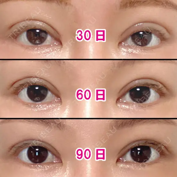 二重切開 / 眼瞼下垂（切開） / 上まぶたの脂肪取り / タレ目形成・グラマラスライン（切開） / 目尻靭帯移動 エイペックス美容外科 DAY 105 メイン用