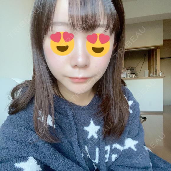 タレ目形成・グラマラスライン（切開） / 切開リフト ドクターゴールドマンクリニック 東京高輪院 DAY 92 メイン用