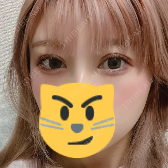 二重切開 松下皮フ形成外科 DAY 9 メイン用