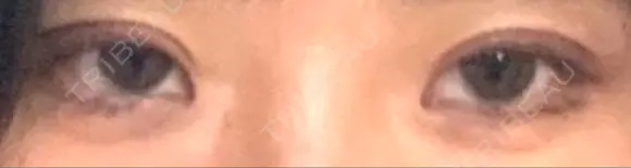 二重切開 郡山タウン形成外科クリニック DAY 19 メイン用