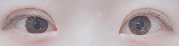 二重切開 / 目元修正 水の森美容クリニック 名古屋院 DAY 29 メイン用