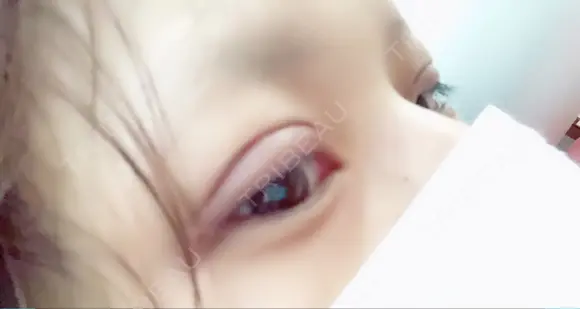 二重埋没 メディカルビューティセンター DAY 1 メイン用