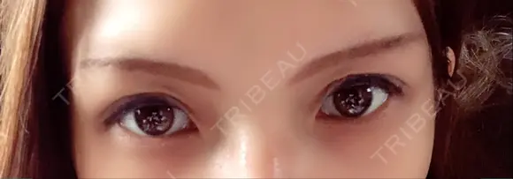 二重埋没 メディカルビューティセンター DAY 2 メイン用