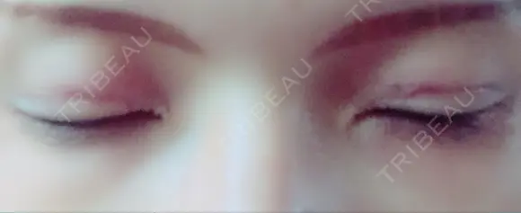 二重埋没 メディカルビューティセンター DAY 2 メイン用