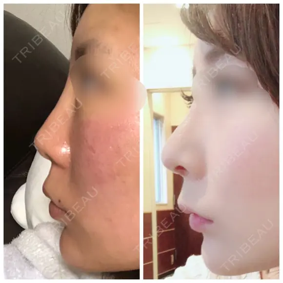 鼻尖形成（切開） / 鼻中隔延長（切開） / 軟骨移植 / 鼻翼基部形成（貴族手術） HANABI整形外科 AFTER メイン用