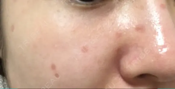 ほくろ・いぼ切除（肌） / ほくろ・いぼ除去レーザー（肌） 赤坂メディカルMクリニック DAY 44 メイン用