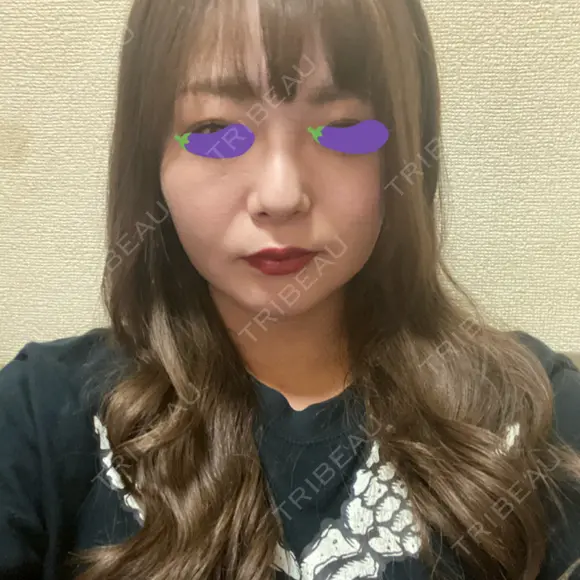 脂肪吸引（顔） 表参道スキンクリニック 表参道院 DAY 115 メイン用