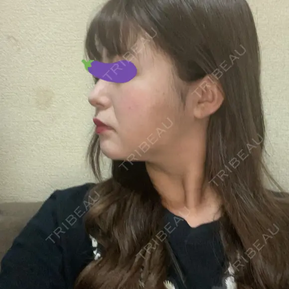 脂肪吸引（顔） 表参道スキンクリニック 表参道院 DAY 115 メイン用