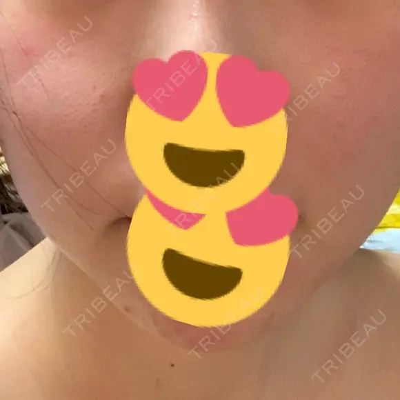 ヒアルロン酸注入（あご） 聖心美容クリニック 大阪院 DAY 35 メイン用