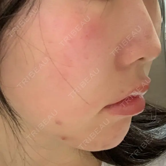 ヒアルロン酸注入（あご） 聖心美容クリニック 大阪院 DAY 35 メイン用