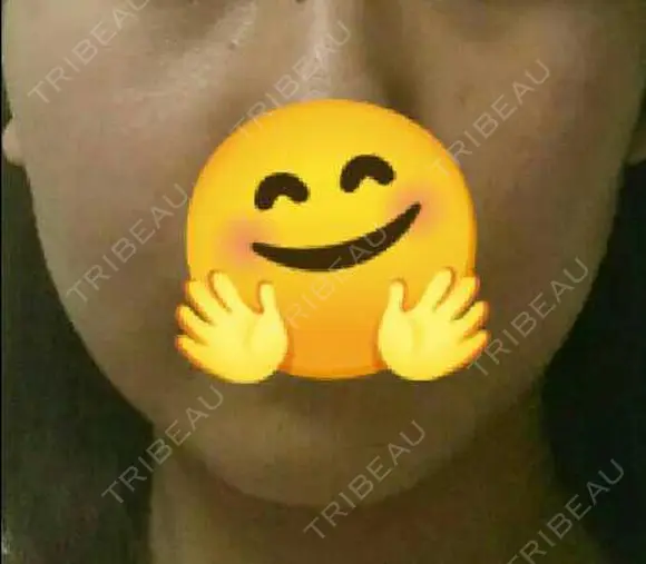 脂肪溶解注射（顔） 赤坂プレミアクリニック DAY 3 メイン用