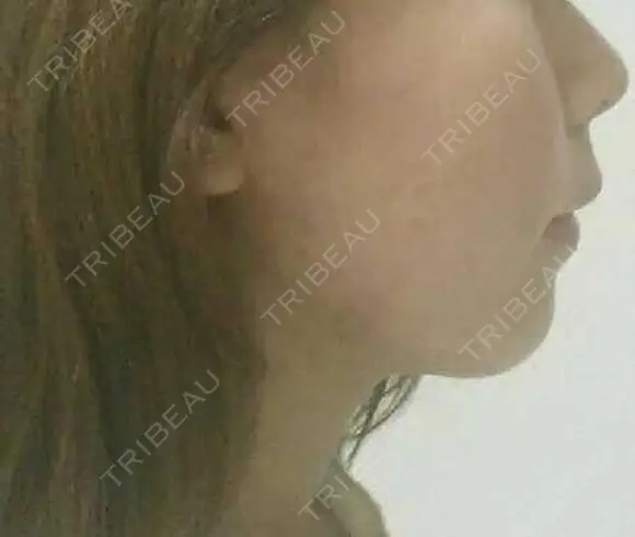 脂肪溶解注射（顔） 赤坂プレミアクリニック DAY 3 メイン用