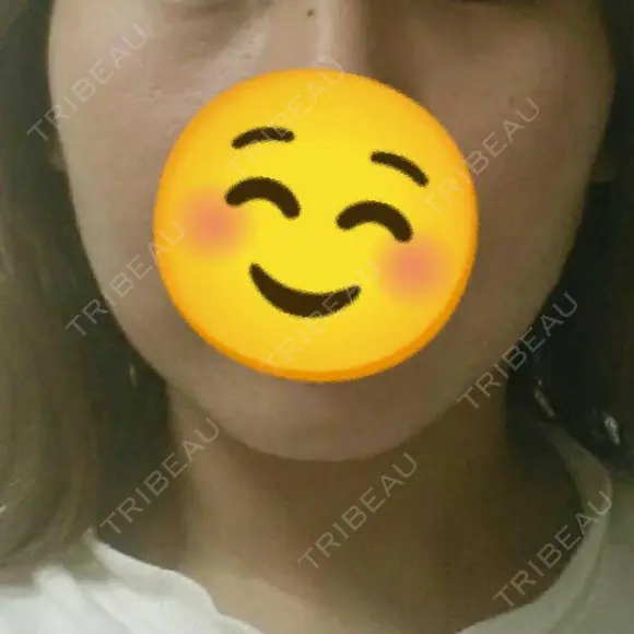 脂肪溶解注射（顔） 赤坂プレミアクリニック DAY 9 メイン用