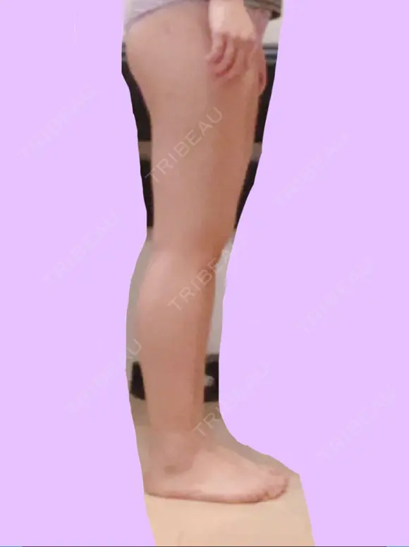 脂肪吸引（脚） 宇都宮竹内クリニック DAY 23 メイン用