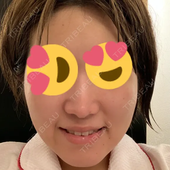 脂肪溶解注射（顔） 赤坂プレミアクリニック DAY 29 メイン用