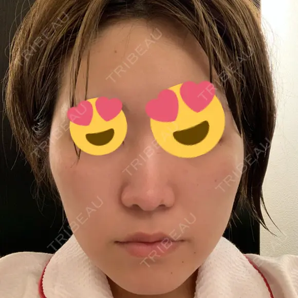 脂肪溶解注射（顔） 赤坂プレミアクリニック AFTER メイン用
