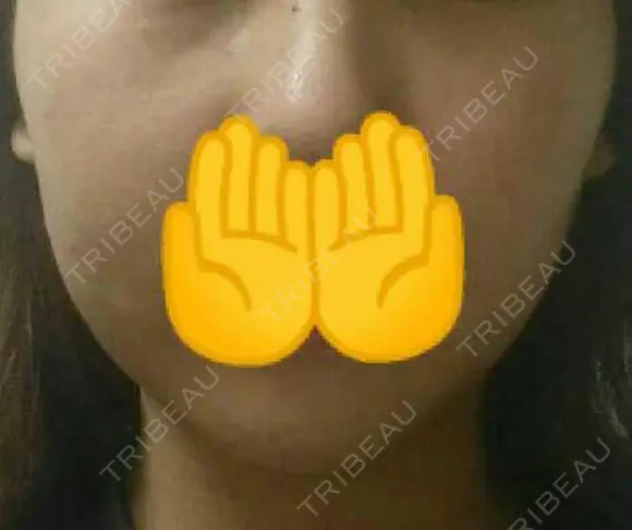 脂肪溶解注射（顔） 赤坂プレミアクリニック DAY 10 メイン用