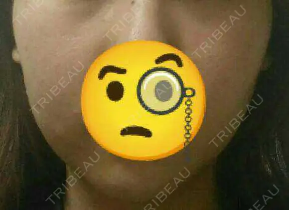 脂肪溶解注射（顔） 赤坂プレミアクリニック DAY 7 メイン用