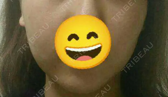 脂肪溶解注射（顔） 赤坂プレミアクリニック DAY 5 メイン用