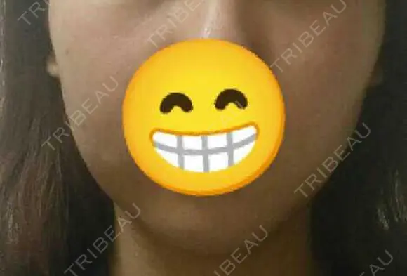 脂肪溶解注射（顔） 赤坂プレミアクリニック AFTER メイン用