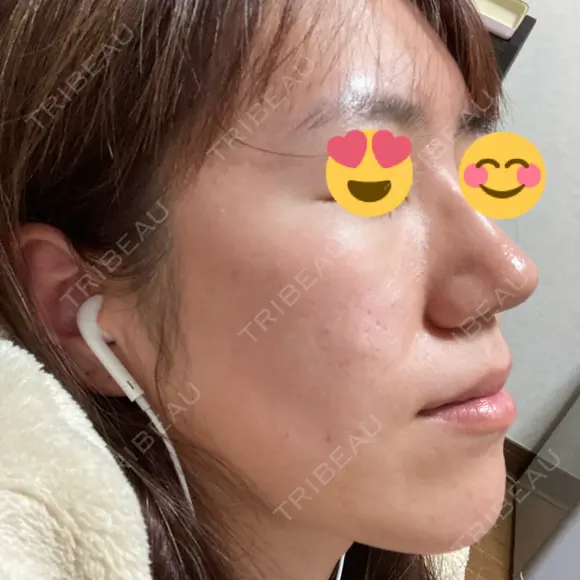 脂肪溶解注射（顔） / PRP皮膚再生療法 閉院｜プルージュ美容クリニック 赤羽院 DAY 24 メイン用