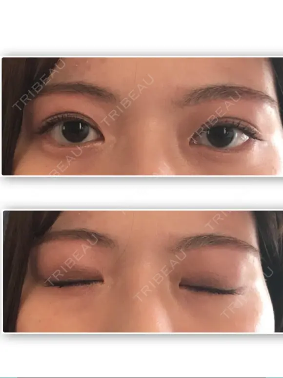 二重埋没 / 上まぶたの脂肪取り / 眉下切開 湘南美容クリニック 高田馬場院 DAY 57 メイン用