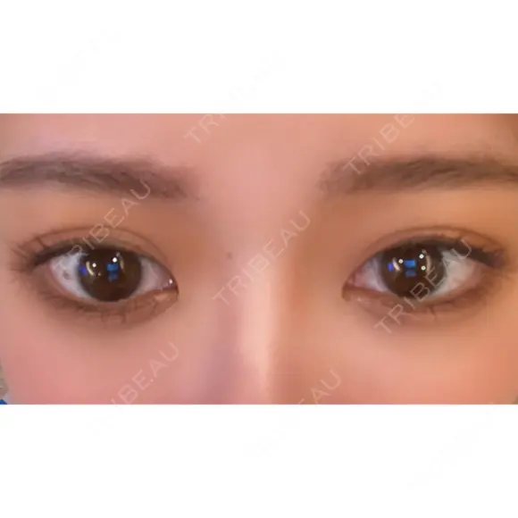 二重切開 / タレ目形成・グラマラスライン（切開） ハナキクリニック DAY 53 メイン用