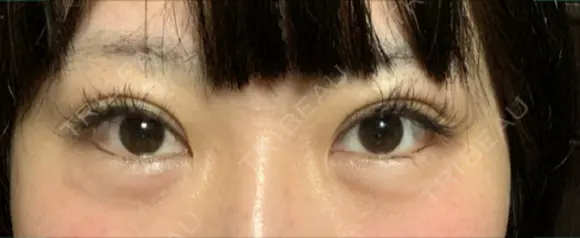 ヒアルロン酸注入（涙袋） 聖心美容クリニック 大阪院 DAY 1 メイン用