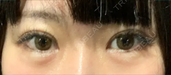 ヒアルロン酸注入（涙袋） 聖心美容クリニック 大阪院 DAY 1 メイン用