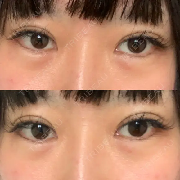 ヒアルロン酸注入（涙袋） 聖心美容クリニック 大阪院 DAY 1 メイン用