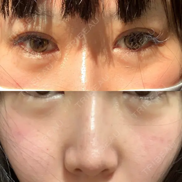ヒアルロン酸注入（涙袋） 聖心美容クリニック 大阪院 AFTER メイン用