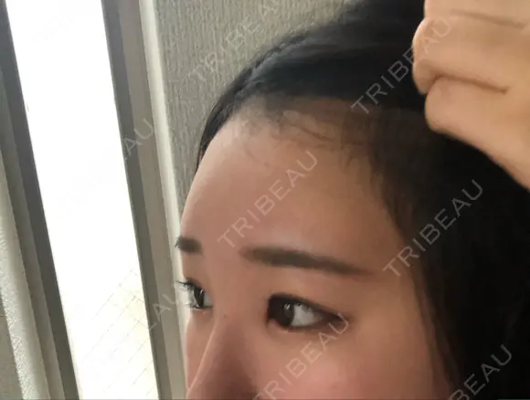ヒアルロン酸注入（額） 東京イセアクリニック DAY 2 メイン用